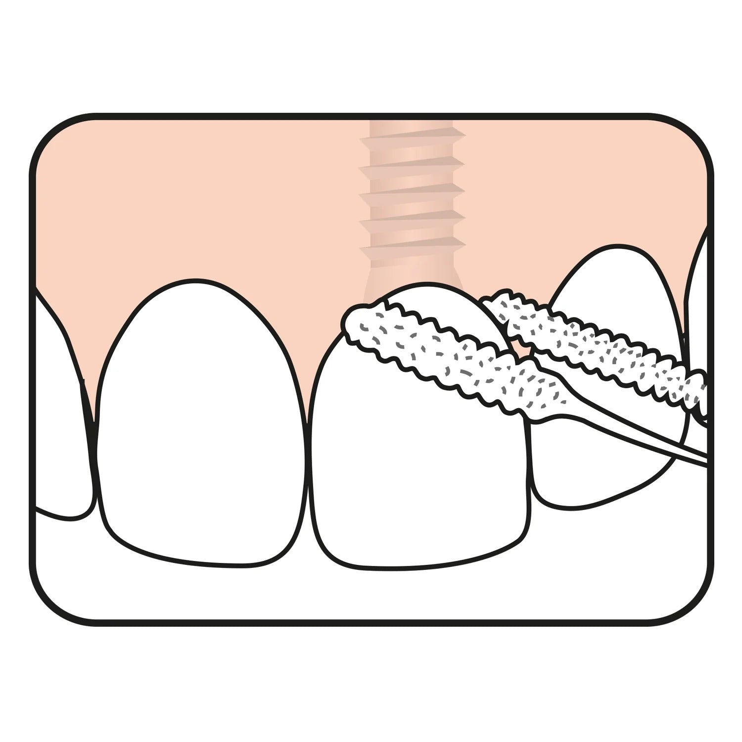 Hilo Dental Para Implante Tepe Bridge & Implant Floss 30 Pz